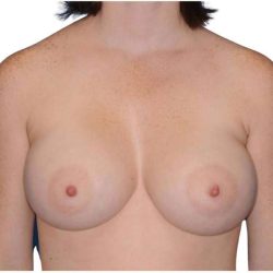 Breast Augmentation Before & After Patient #733