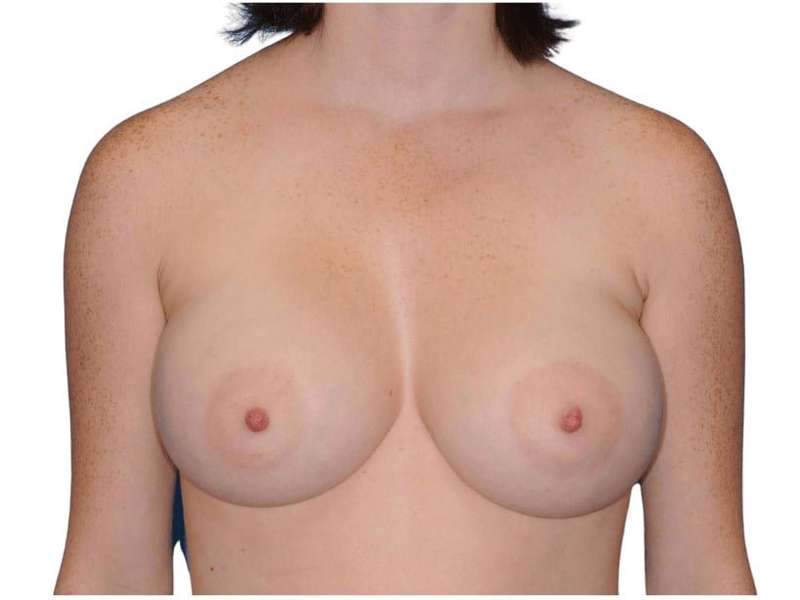 Breast Augmentation Before & After Patient #733