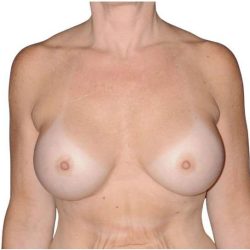 Breast Augmentation Before & After Patient #740