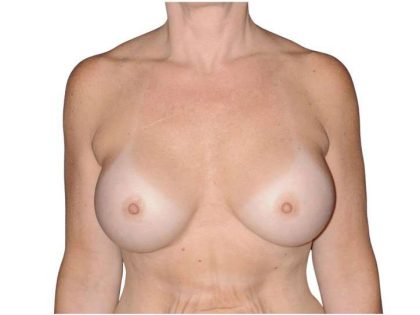Breast Augmentation Before & After Patient #740