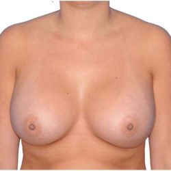 Breast Augmentation Before & After Patient #747