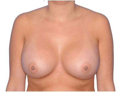 Breast Augmentation Before & After Patient #747