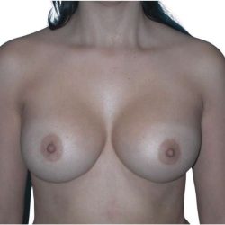 Breast Augmentation Before & After Patient #754