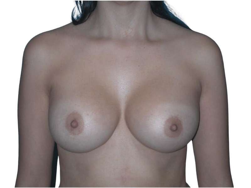 Breast Augmentation Before & After Patient #754