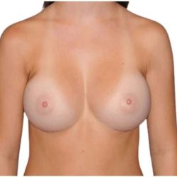 Breast Augmentation Before & After Patient #761