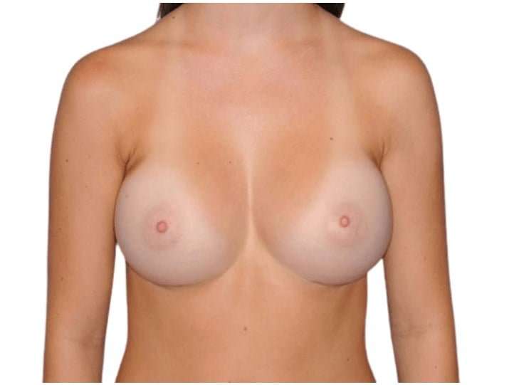 Breast Augmentation Before & After Patient #761
