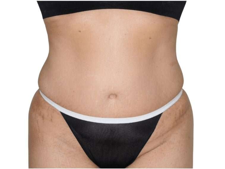 Tummy Tuck Before & After Patient #448