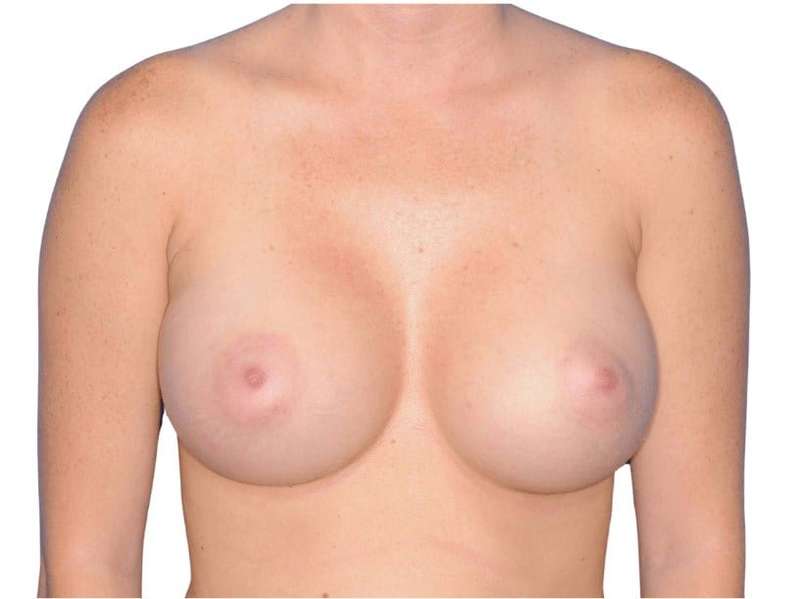 Breast Augmentation Before & After Patient #768