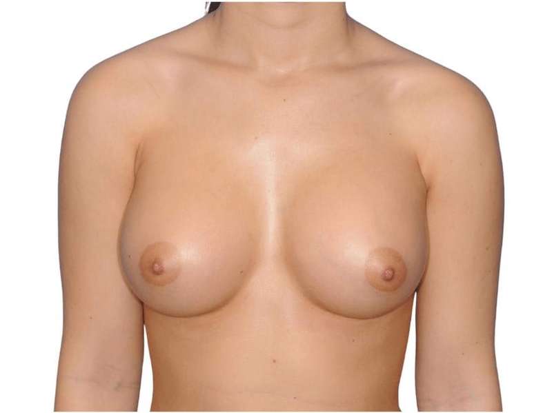 Breast Augmentation Before & After Patient #775