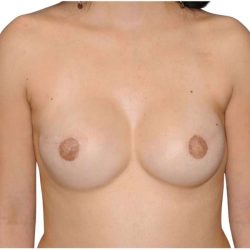 Breast Reconstruction Before & After Patient #782