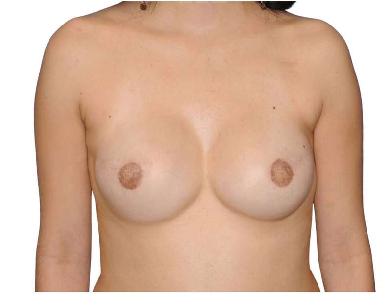Breast Reconstruction Before & After Patient #782