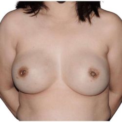 Breast Reconstruction Before & After Patient #787