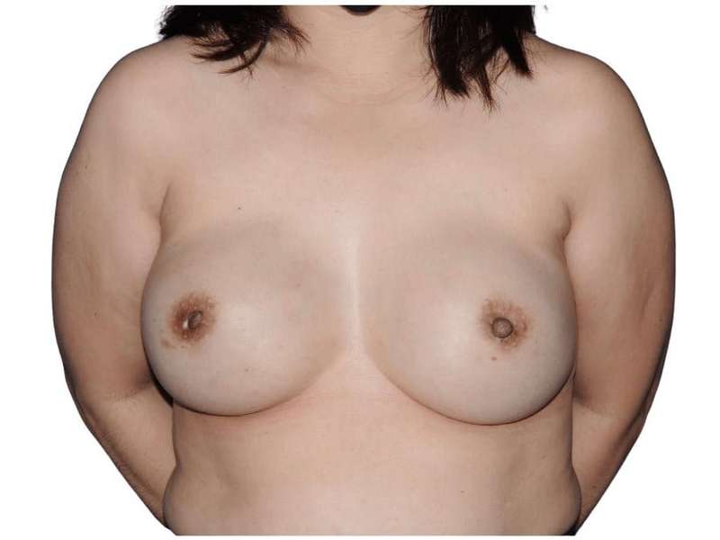 Breast Reconstruction Before & After Patient #787