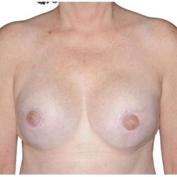 Breast Reconstruction Before & After Patient #810