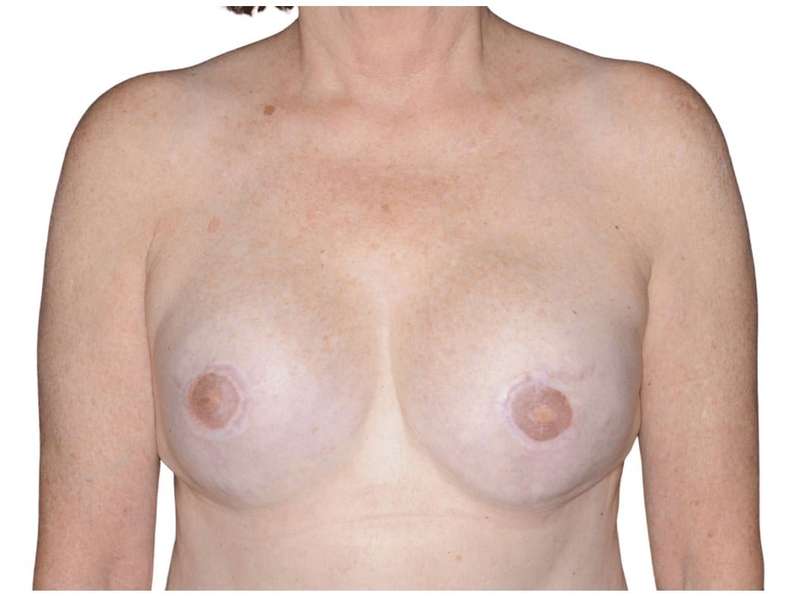 Breast Reconstruction Before & After Patient #810