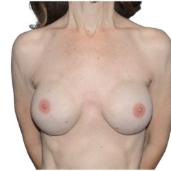 Breast Reconstruction Before & After Patient #821