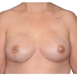 Breast Reconstruction Before & After Patient #828