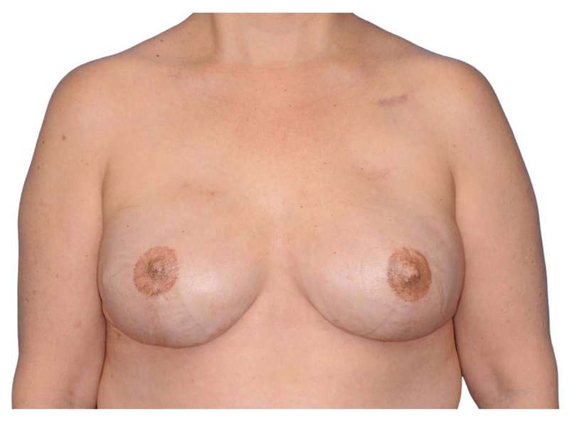 Breast Reconstruction Before & After Patient #828