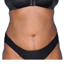 Tummy Tuck Before & After Patient #454