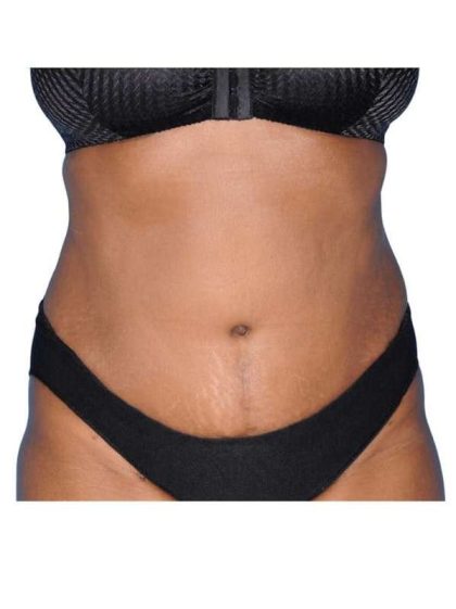 Tummy Tuck Before & After Patient #454