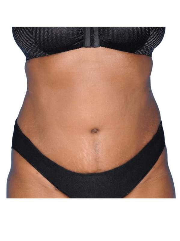 Tummy Tuck Before & After Patient #454