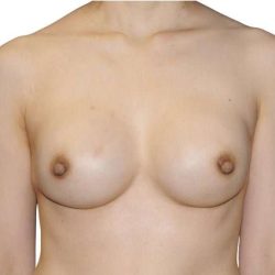 Breast Reconstruction Before & After Patient #880