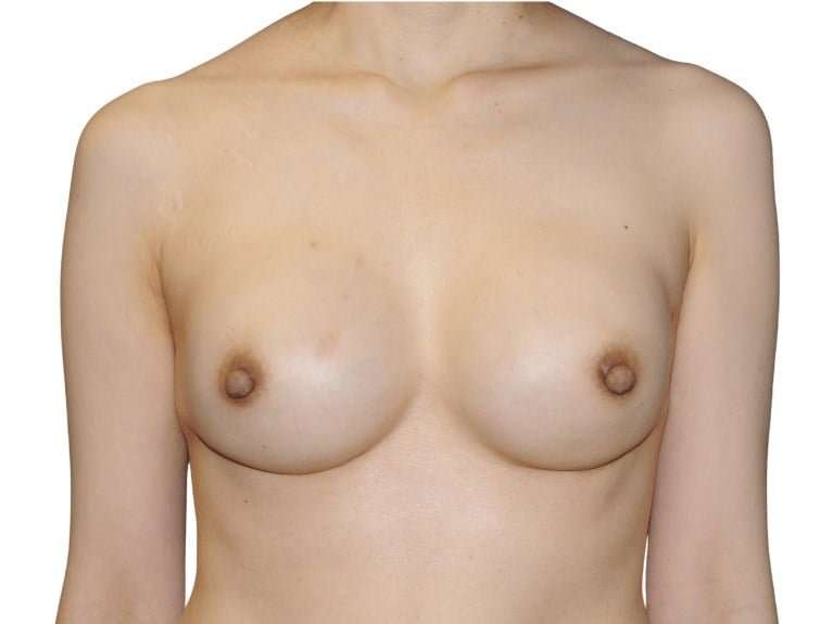 Breast Reconstruction Before & After Patient #880
