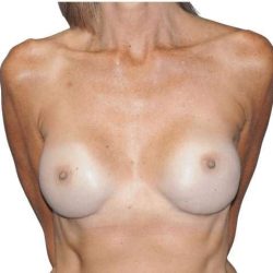 Breast Reconstruction Before & After Patient #891