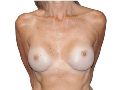 Breast Reconstruction Before & After Patient #891