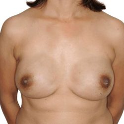 Breast Reconstruction Before & After Patient #898
