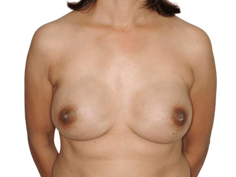 Breast Reconstruction Before & After Patient #898