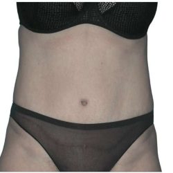 Tummy Tuck Before & After Patient #459