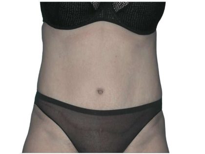 Tummy Tuck Before & After Patient #459