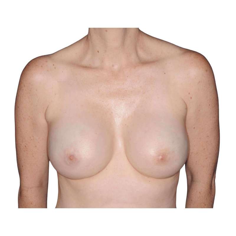 Breast Reconstruction Before & After Patient #930