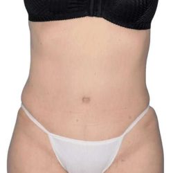Tummy Tuck Before & After Patient #464