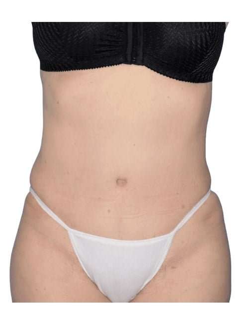 Tummy Tuck Before & After Patient #464