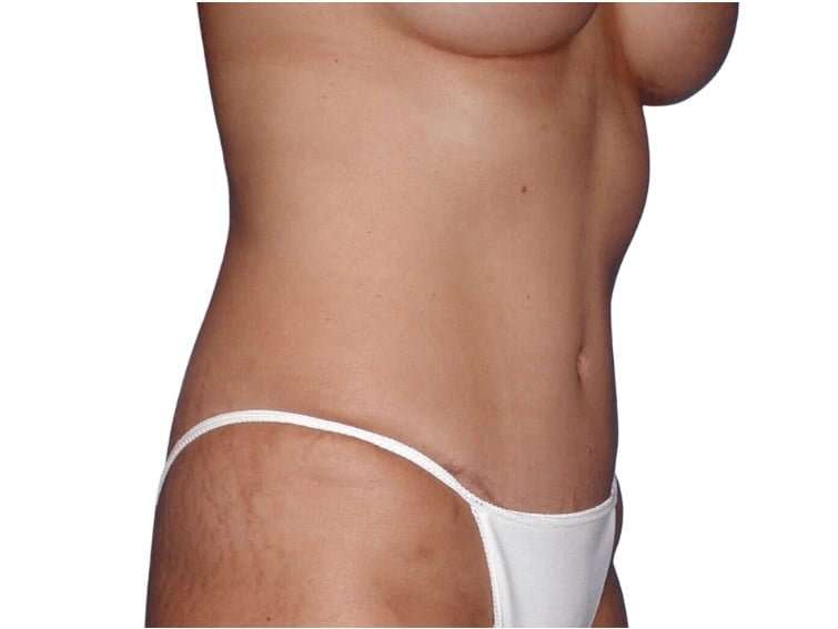 Tummy Tuck Before & After Patient #469