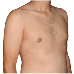 Gynecomastia Before & After Patient #515