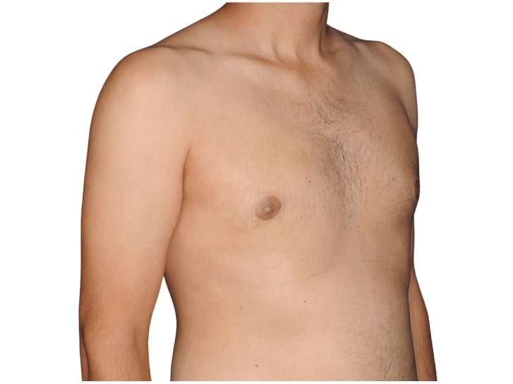 Gynecomastia Before & After Patient #515