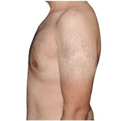 Gynecomastia Before & After Patient #525