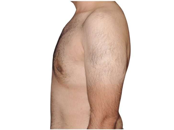 Gynecomastia Before & After Patient #525