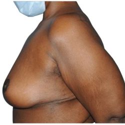 Breast Lift Before & After Patient #538
