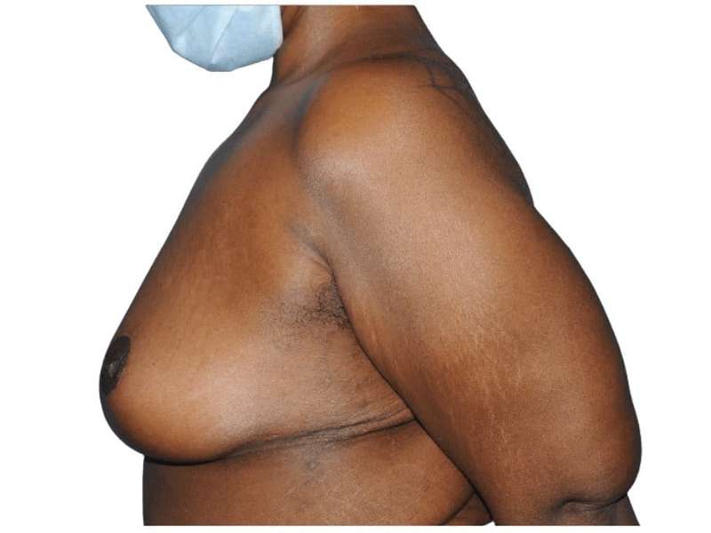 Breast Lift Before & After Patient #538