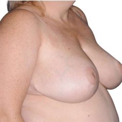 Breast Reduction Before & After Patient #579