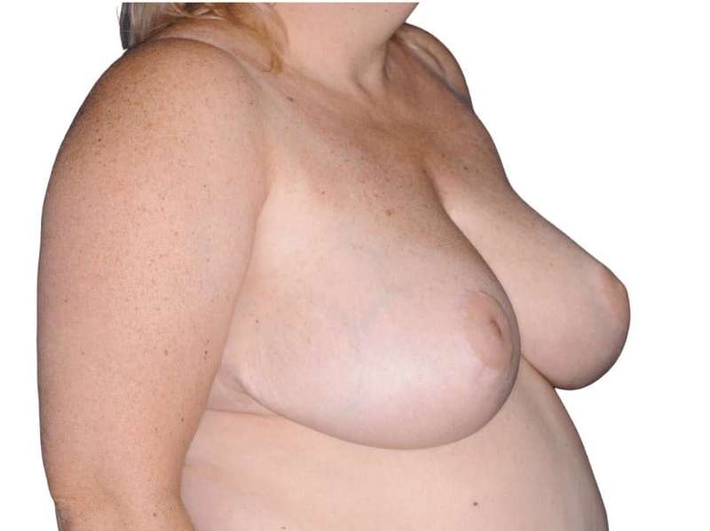Breast Reduction Before & After Patient #579