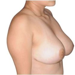 Breast Reduction Before & After Patient #593