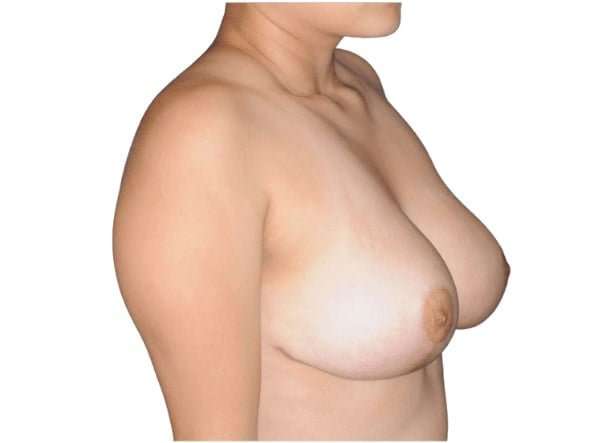 Breast Reduction Before & After Patient #593