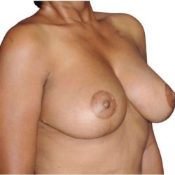 Breast Reduction Before & After Patient #630