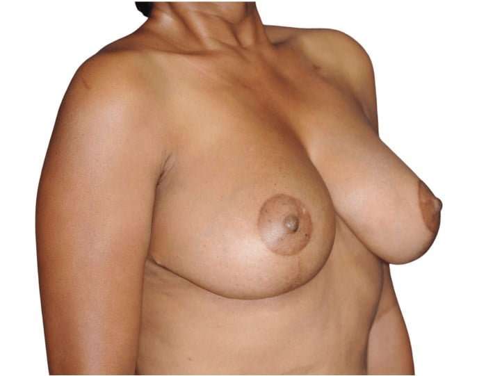 Breast Reduction Before & After Patient #630