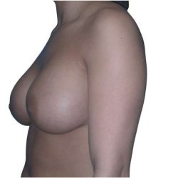Breast Augmentation Before & After Patient #670
